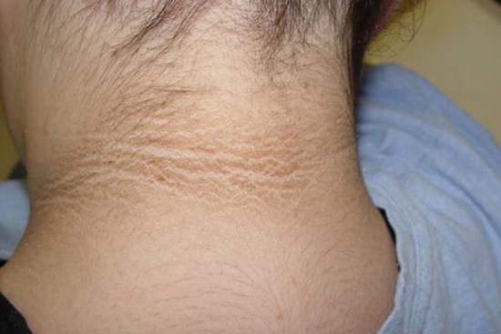 3 thay đổi bất thường trên cổ đang ngầm cảnh báo tế bào ung thư chực chờ 