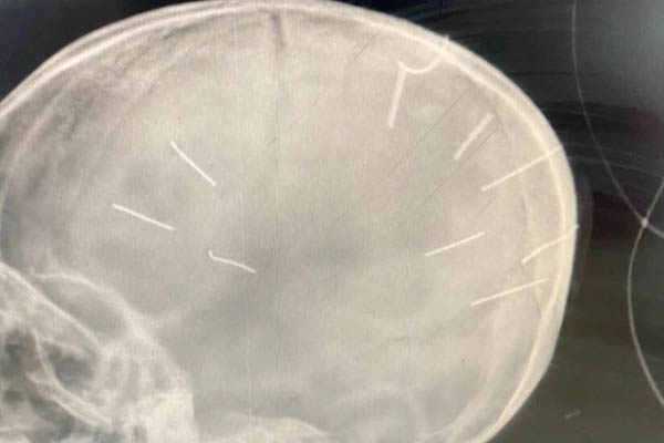 Bé gái 3 tuổi ở Hà Nội bị 9 chiếc đinh găm vào đầu: Từng hôn mê vì ngộ độc thuốc trừ sâu, 3 tháng nhập viện 3 lần-2