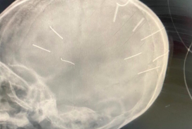 Bé gái 3 tuổi ở Hà Nội bị 9 chiếc đinh găm vào đầu: Từng hôn mê vì ngộ độc thuốc trừ sâu, 3 tháng nhập viện 3 lần-1