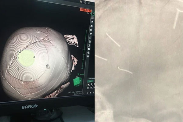 Vụ bé gái có 9 vật giống đinh trong đầu: Bệnh viện bác tin bé đã tử vong-1