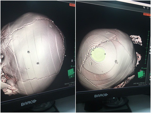 Bé 3 tuổi nghi bị bạo hành ở Hà Nội với 9 chiếc đinh găm vào sọ: Cần khởi tố vụ án để điều tra làm rõ-2