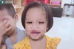 Bé gái 3 tuổi nghi bị bạo hành ở Hà Nội: Nhiều vết thương trên đầu lâu ngày đã đóng vẩy, cánh tay từng phải bó bột cách đây 2 tuần-3