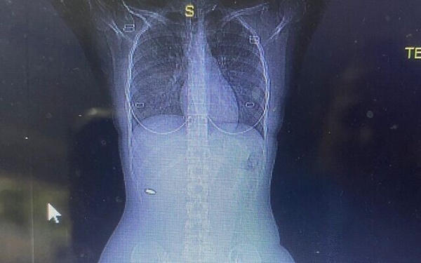 Đang dự đám cưới bạn, cô gái đột nhiên thấy người đau đớn, 3 tháng sau đi kiểm tra phát hiện sự thật không ngờ-2