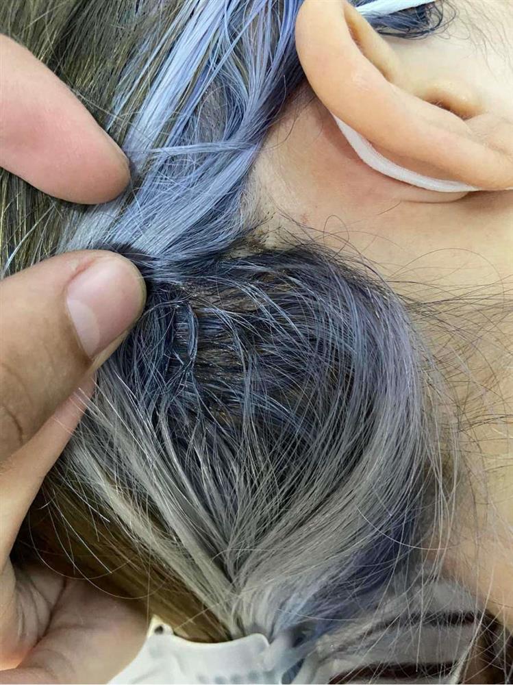 Tẩy tóc chơi Tết, ngồi 11 tiếng nhận về cái kết cháy da đầu, chảy dịch mủ-5