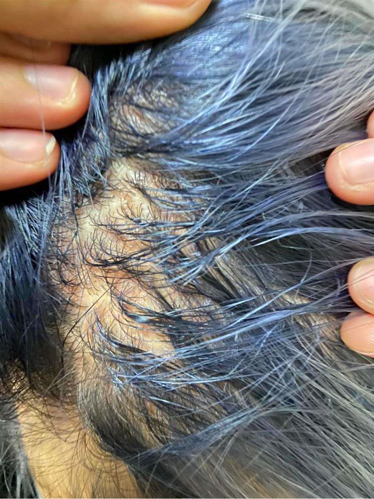 Tẩy tóc chơi Tết, ngồi 11 tiếng nhận về cái kết cháy da đầu, chảy dịch mủ-6