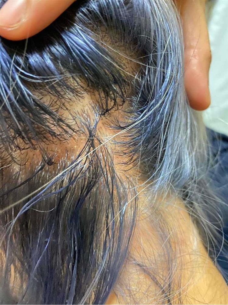 Tẩy tóc chơi Tết, ngồi 11 tiếng nhận về cái kết cháy da đầu, chảy dịch mủ-7
