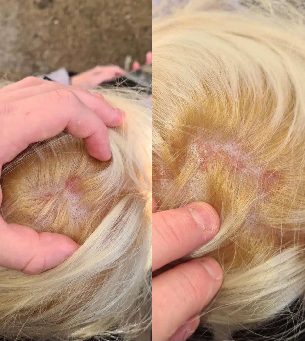 Tẩy tóc chơi Tết, ngồi 11 tiếng nhận về cái kết cháy da đầu, chảy dịch mủ-11