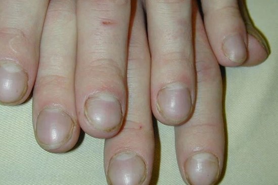 Tế bào ung thư phổi cực thích những người có