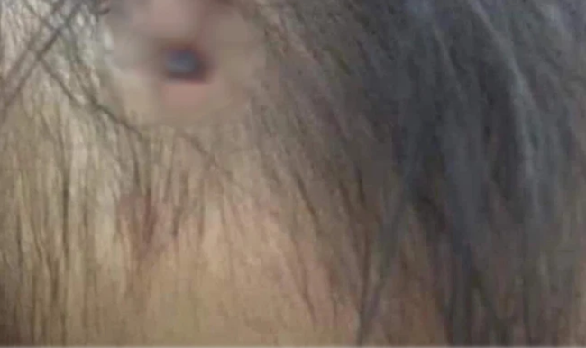 Sự thật về bức ảnh chiếc đinh găm vào đầu cháu bé được cho là nạn nhân nghi án bạo hành ở Hà Nội-1