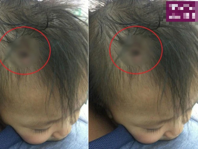 Sự thật về bức ảnh chiếc đinh găm vào đầu cháu bé được cho là nạn nhân nghi án bạo hành ở Hà Nội-2