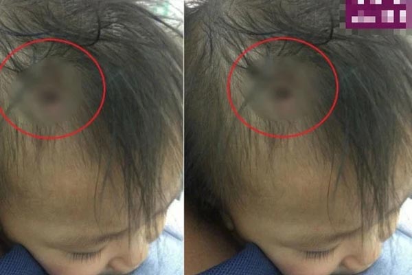 Tình hình sức khoẻ hiện tại của bé gái nghi bị người tình của mẹ đóng đinh vào đầu-2