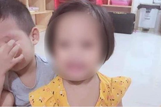 Tình hình sức khoẻ hiện tại của bé gái nghi bị người tình của mẹ đóng đinh vào đầu