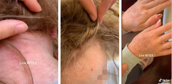 Bé gái mang quả đầu tổ quạ, chấy rận bò xuống cả tay để hút máu khiến chủ tiệm choáng váng lập tức gọi cơ quan bảo vệ trẻ em-3