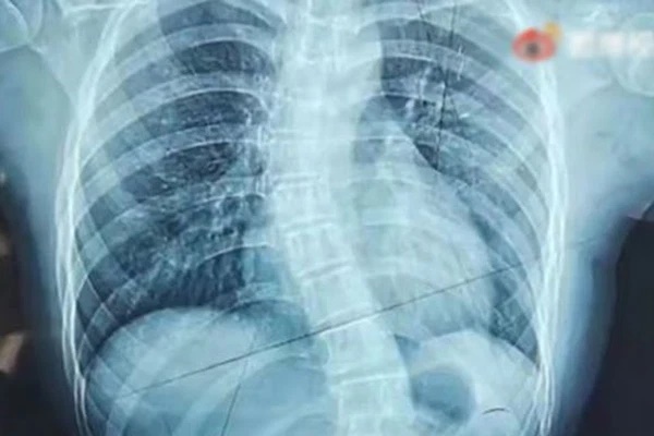 Nữ sinh 15 tuổi nhập viện vì đau lưng, cột sống biến dạng thành chữ S, tay dài tay ngắn, chân không bằng nhau chỉ vì 1 thứ rất nhiều người trẻ thường đeo trên lưng-1