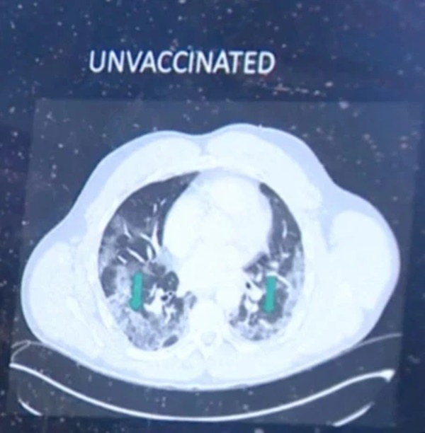 So ảnh X-quang của người đã tiêm và chưa tiêm vaccine Covid-19, rút ra kết luận kinh ngạc-3
