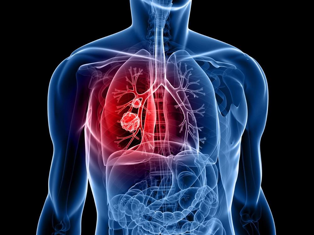 5 dấu hiệu sớm của ung thư phổi bạn cần biết-1
