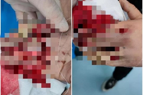 1 tháng tiếp nhận 5 trường hợp đứt lìa ngón tay, bác sĩ nhắc nhở cẩn thận kẻo tự gây thương tích khi Tết đang cận kề
