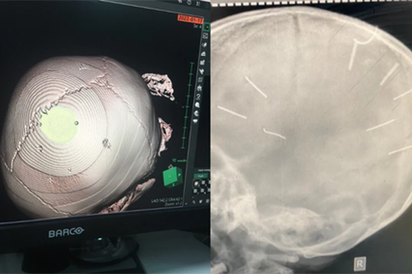 Bé 3 tuổi bị đóng đinh có tiến triển về sức khỏe, chuẩn bị cho ca mổ-2