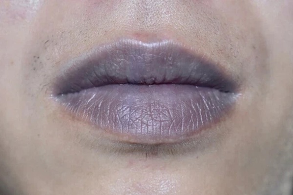 3 nơi trên cơ thể chuyển sang màu đen là tín hiệu sớm cảnh báo phổi đang bị tổn thương-1