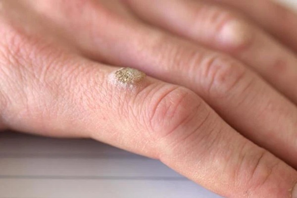 Nữ sinh 17 tuổi mặt bỗng nổi đầy mụn lạ do nhiễm virus HPV vì thói quen giặt đồ của nhiều gia đình-4