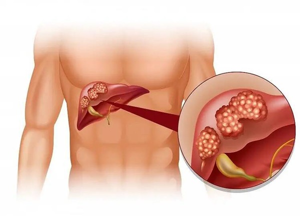 Ung thư gan thích nhất khi bạn ăn 3 loại thực phẩm, Tết này dù thích mấy cũng nên tránh xa, thấy 6 tín hiệu thì cần đi khám ngay còn kịp-4