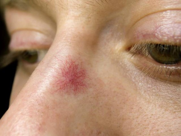 Từ gan nhiễm mỡ sang ung thư gan rất nhanh: 5 triệu chứng để bạn nhận biết bệnh ngay từ sớm-4