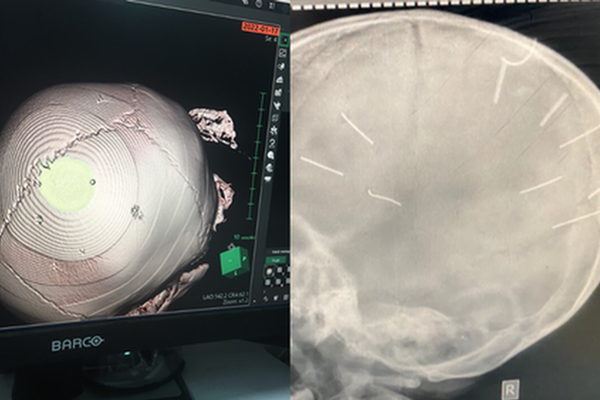 Cập nhật sức khoẻ bé gái 3 tuổi ở Hà Nội bị nhân tình của mẹ đóng đinh vào đầu: Đã được tháo bột ở cánh tay nhưng vẫn hôn mê-1