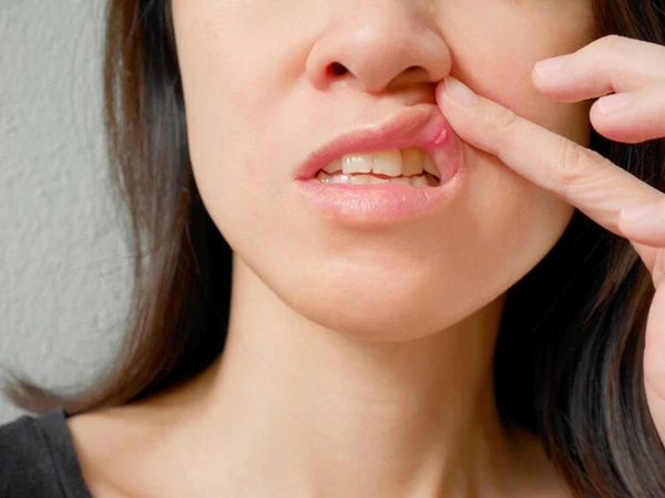 4 hiện tượng xuất hiện ở vùng miệng cho thấy gan đang có vấn đề, đừng chủ quan kẻo hối hận không kịp-3