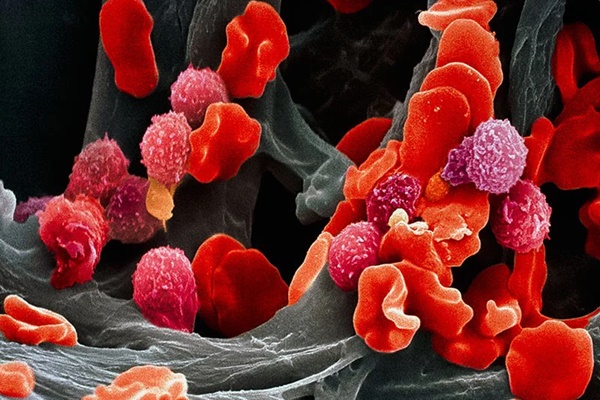 Hai bệnh nhân đầu tiên khỏi ung thư máu nhờ phương pháp mới-3