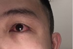 4 nhóm người dễ có nguy cơ mắc hội chứng khô mắt, nếu không sửa ngay sẽ rất tai hại-5