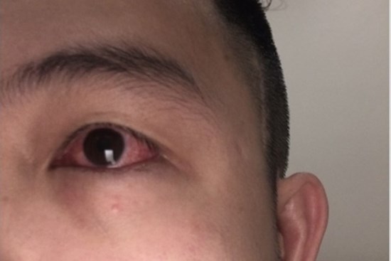 F0 bị đỏ mắt, bác sĩ cảnh báo 'triệu chứng không thể chủ quan'