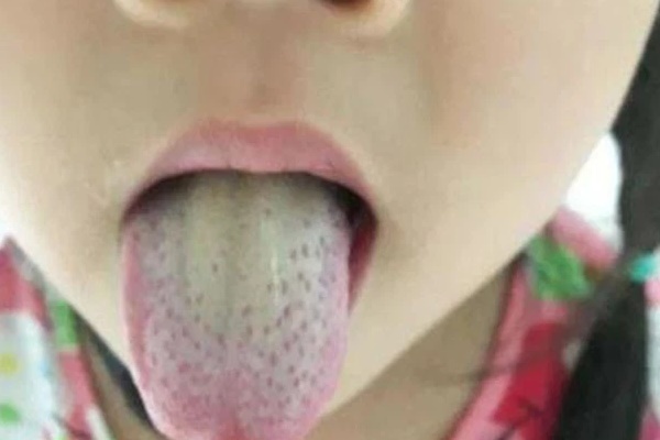 5 biểu hiện ở lưỡi cho thấy cơ thể đang có bệnh, nếu không có cái nào chứng tỏ bạn đang rất khỏe mạnh-2