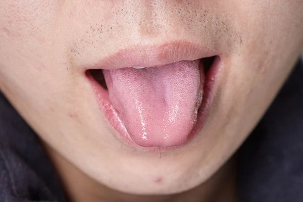 5 biểu hiện ở lưỡi cho thấy cơ thể đang có bệnh, nếu không có cái nào chứng tỏ bạn đang rất khỏe mạnh-3
