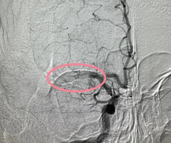 Chàng trai 20 tuổi bị nhồi máu não dù không béo phì, hút thuốc hay uống rượu, nguyên nhân xuất phát từ thói quen mà người trẻ thường làm hàng đêm-1