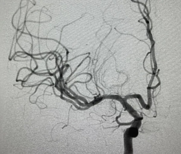 Chàng trai 20 tuổi bị nhồi máu não dù không béo phì, hút thuốc hay uống rượu, nguyên nhân xuất phát từ thói quen mà người trẻ thường làm hàng đêm-3
