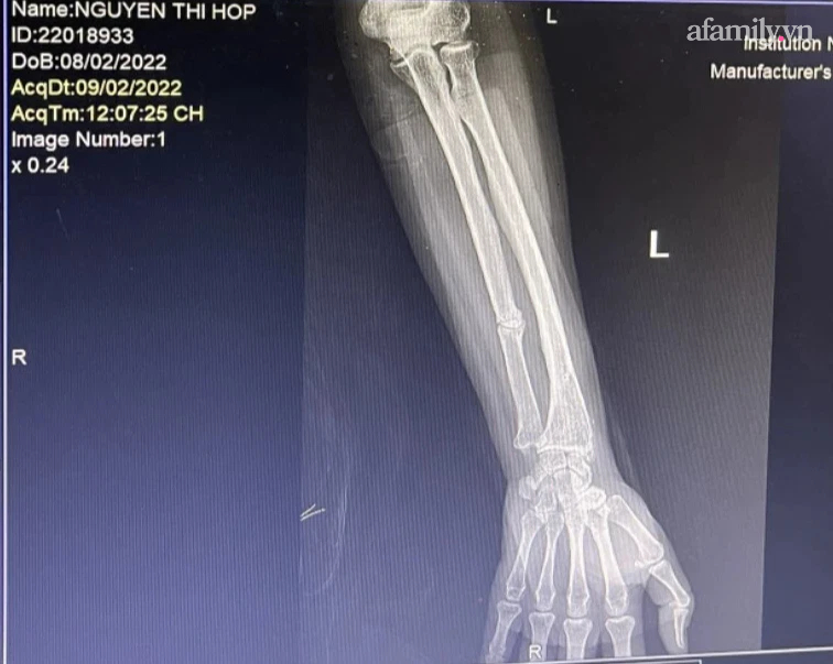 2 phụ nữ tố bị nhóm đàn ông cùng dòng họ xông vào tận nhà đánh đập khiến 1 người gãy tay, tài sản hàng trăm triệu đồng bị vơ vét-2