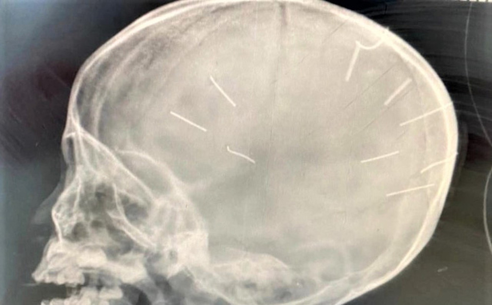 Bé gái 3 tuổi bị người tình của mẹ đóng đinh vào đầu hiện sức khỏe ra sao?-1