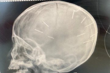 Sức khỏe bé gái bị đinh găm vào đầu tiên lượng xấu-1