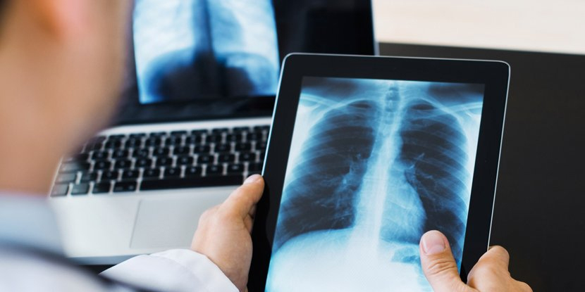 Ho kéo dài bao lâu là dấu hiệu ung thư phổi?-1