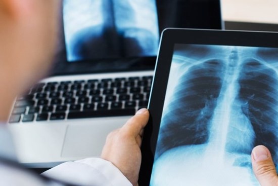 Ho kéo dài bao lâu là dấu hiệu ung thư phổi?