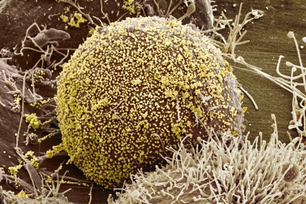 Nữ bệnh nhân HIV đầu tiên được chữa khỏi-1