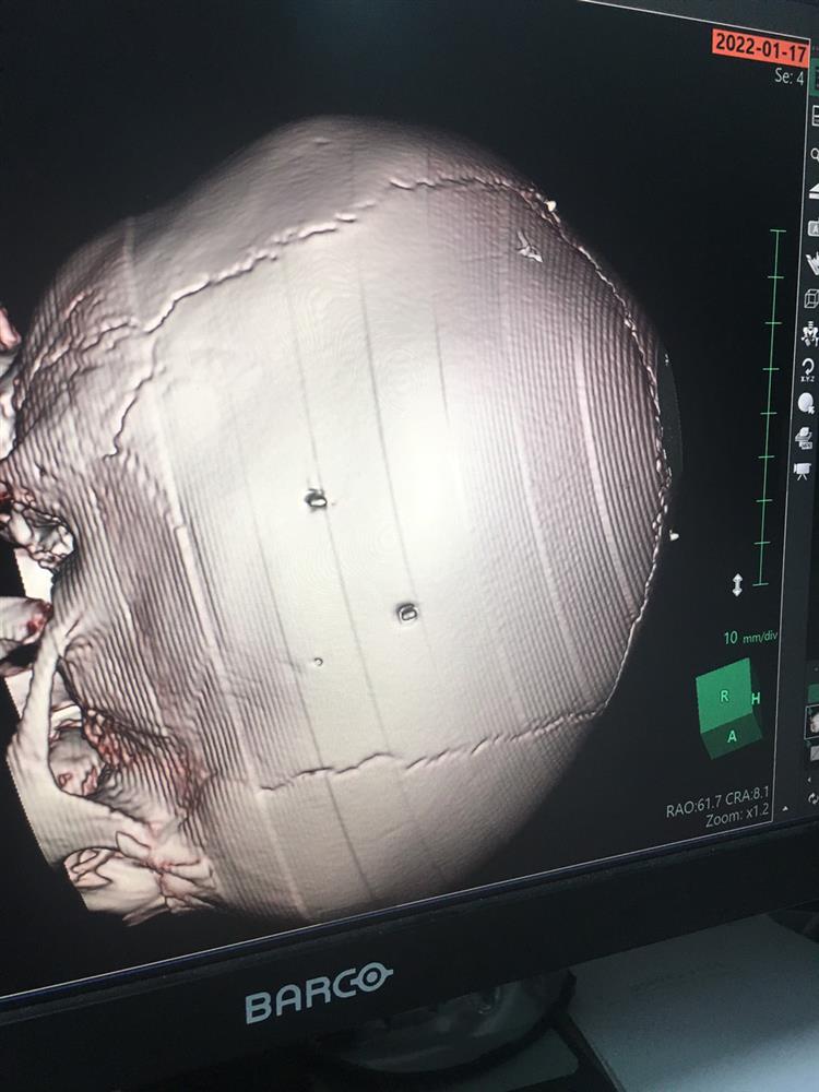 Thông tin mới nhất từ bệnh viện về bé 3 tuổi bị người tình của mẹ đóng đinh vào đầu-2