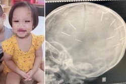 Thông tin mới nhất từ bệnh viện về bé 3 tuổi bị người tình của mẹ đóng đinh vào đầu