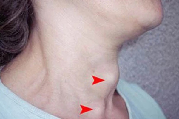 Người có phổi xấu thường có 3 triệu chứng, nếu bạn không bị cái nào thì bộ thở vẫn còn khỏe chán-3