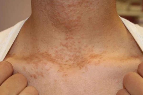 Một nhóm nữ sinh 21 tuổi cùng lúc phát hiện mọc nhiều nốt mụn li ti trên cổ, hóa ra nhiễm virus HPV chỉ vì 1 hành động khi ở chung-1