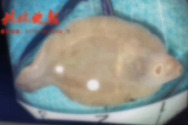 Người phụ nữ mất 1/3 lá gan chỉ vì loại rau sống nhiều người thích, bác sĩ cũng hoảng hồn khi gắp 1 con vật gần 4cm từ ống mật-2