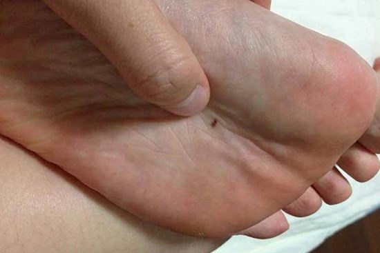 2 hiện tượng bất thường xuất hiện ở lòng bàn tay, lòng bàn chân cảnh báo tế bào ung thư đang nhen nhóm phát triển