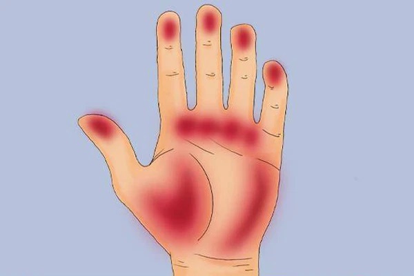 2 hiện tượng bất thường xuất hiện ở lòng bàn tay, lòng bàn chân cảnh báo tế bào ung thư đang nhen nhóm phát triển-2
