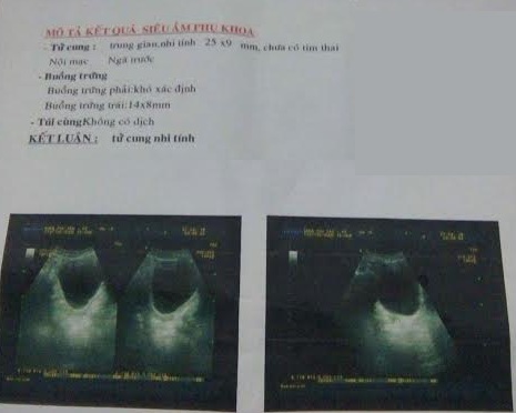 7 năm không có kinh, cô gái đi khám thì phát hiện tử cung nhi hoá, nhà chồng hủy hôn trong phút mốt vì sợ không có người nối dõi-2