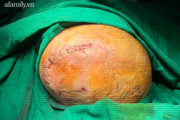 Nắm đuôi chú chó cưng trong nhà, bé gái 6 tháng tuổi đang tập bò bị cắn xuyên vào sọ-2